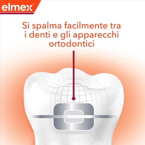 Dente con apparecchio ortodontico che mostra come il dentifricio si spalma facilmente tra i denti e l’apparecchio.